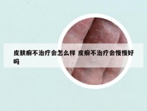 皮肤癣不治疗会怎么样 皮癣不治疗会慢慢好吗