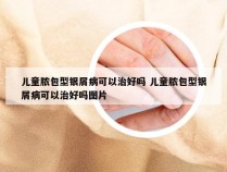 儿童脓包型银屑病可以治好吗 儿童脓包型银屑病可以治好吗图片