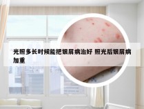 光照多长时候能把银屑病治好 照光后银屑病加重