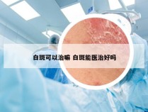 白斑可以治嘛 白斑能医治好吗