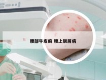 腰部牛皮癣 腰上银屑病