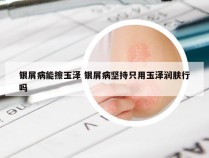 银屑病能擦玉泽 银屑病坚持只用玉泽润肤行吗