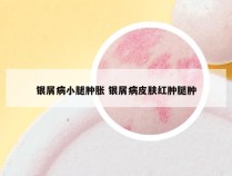 银屑病小腿肿胀 银屑病皮肤红肿腿肿