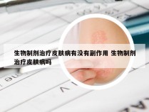 生物制剂治疗皮肤病有没有副作用 生物制剂治疗皮肤病吗