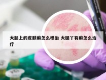 大腿上的皮肤癣怎么根治 大腿丫有癣怎么治疗