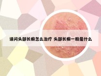 请问头部长癣怎么治疗 头部长癣一般是什么