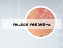 手腕上起白斑 手腕起白斑是什么