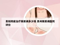 贵阳彻底治疗银屑病多少钱 贵州银屑病医院评价