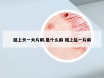 腿上长一大片癣,是什么癣 腿上起一片癣