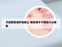 手部银屑病开始裂口 银屑病手干裂擦什么缓解