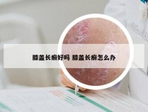 膝盖长癣好吗 膝盖长癣怎么办