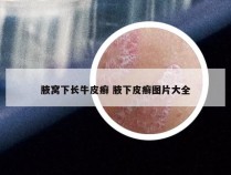 腋窝下长牛皮癣 腋下皮癣图片大全