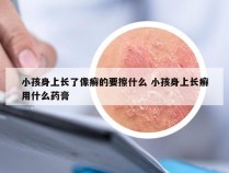 小孩身上长了像癣的要擦什么 小孩身上长癣用什么药膏