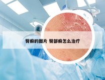 臀癣的图片 臀部癣怎么治疗