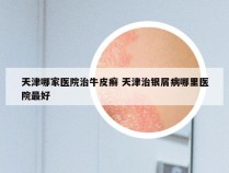 天津哪家医院治牛皮癣 天津治银屑病哪里医院最好