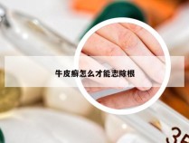 牛皮癣怎么才能志除根