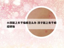 小孩腿上长干燥癣怎么办 孩子腿上有干癣 结硬珈