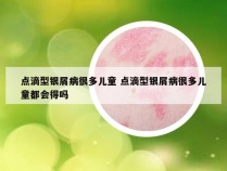 点滴型银屑病很多儿童 点滴型银屑病很多儿童都会得吗