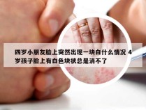 四岁小朋友脸上突然出现一块白什么情况 4岁孩子脸上有白色块状总是消不了