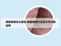 顽固性癣怎么根治 顽固癣用什么药才可以根治啊