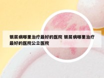 银屑病哪里治疗最好的医院 银屑病哪里治疗最好的医院公立医院