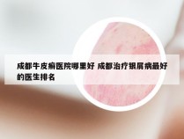 成都牛皮癣医院哪里好 成都治疗银屑病最好的医生排名