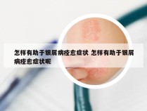 怎样有助于银屑病痊愈症状 怎样有助于银屑病痊愈症状呢