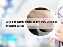 小腿上长癣抹什么都不管用怎么办 小腿长癣很痒用什么药膏