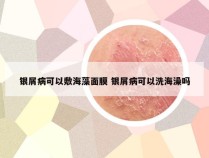 银屑病可以敷海藻面膜 银屑病可以洗海澡吗