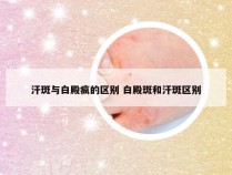 汗斑与白殿疯的区别 白殿斑和汗斑区别