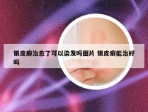 银皮癣治愈了可以染发吗图片 银皮癣能治好吗