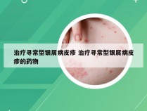 治疗寻常型银屑病皮疹 治疗寻常型银屑病皮疹的药物