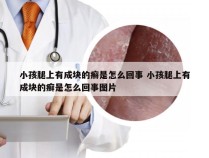 小孩腿上有成块的癣是怎么回事 小孩腿上有成块的癣是怎么回事图片