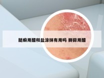 腿癣用醋和盐涂抹有用吗 脚藓用醋