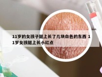 11岁的女孩子腿上长了几块白色的东西 11岁女孩腿上长小红点