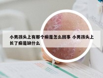 小男孩头上有那个癣是怎么回事 小男孩头上长了癣是缺什么