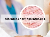 大腿上长癣怎么办图片 大腿上长癣怎么回事