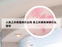 人身上长癣是缺什么吗 身上长癣身体缺什么营养