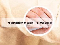 大腿内侧癣图片 百度扫一扫识别皮肤病