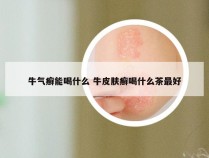 牛气癣能喝什么 牛皮肤癣喝什么茶最好