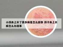 小孩身上长了很多癣是怎么回事 孩子身上长癣怎么办回事