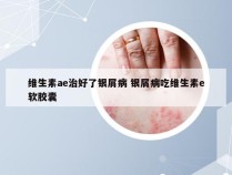 维生素ae治好了银屑病 银屑病吃维生素e软胶囊