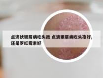 点滴状银屑病吃头孢 点滴银屑病吃头孢好,还是罗红霉素好