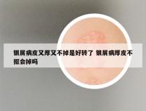 银屑病皮又厚又不掉是好转了 银屑病厚皮不抠会掉吗