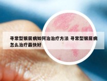 寻常型银屑病如何治治疗方法 寻常型银屑病怎么治疗最快好