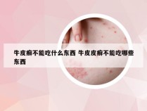 牛皮癣不能吃什么东西 牛皮皮癣不能吃哪些东西