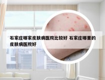 石家庄哪家皮肤病医院比较好 石家庄哪里的皮肤病医院好