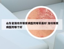 山东省潍坊市银屑病医院哪家最好 潍坊银屑病医院哪个好