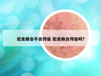 蛇皮癣会不会传染 蛇皮癣会传染吗?