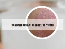 银屑病各期特点 银屑病分几个时期